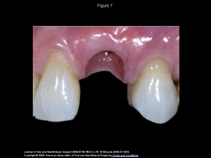 Figure 7 Journal of Oral and Maxillofacial Surgery 2009 6740 -48 DOI: (10. 1016/j.