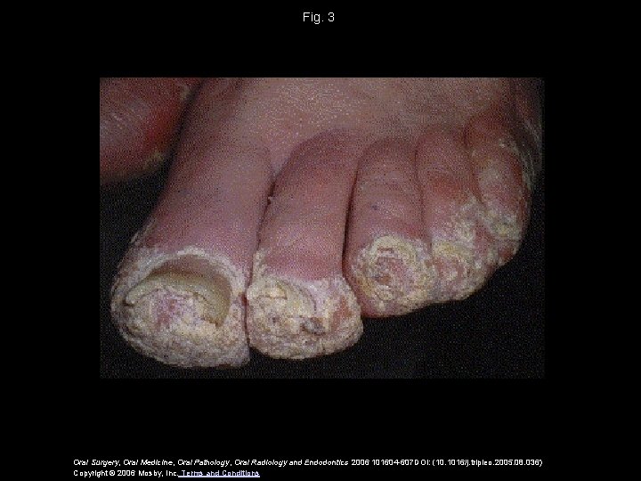 Fig. 3 Oral Surgery, Oral Medicine, Oral Pathology, Oral Radiology and Endodontics 2006 101604