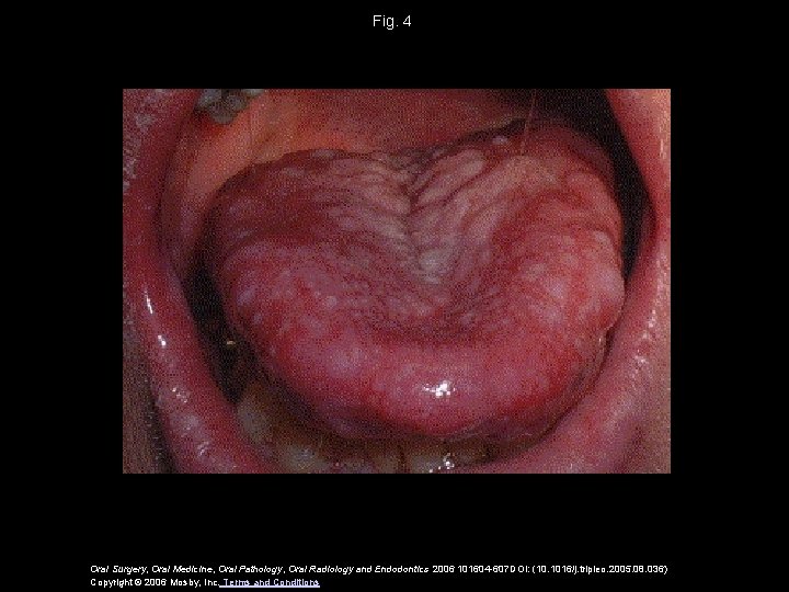 Fig. 4 Oral Surgery, Oral Medicine, Oral Pathology, Oral Radiology and Endodontics 2006 101604