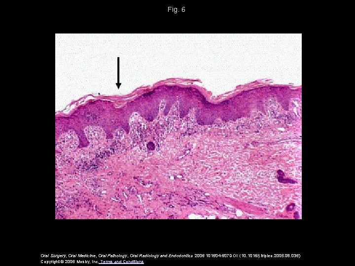 Fig. 6 Oral Surgery, Oral Medicine, Oral Pathology, Oral Radiology and Endodontics 2006 101604