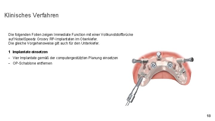 Klinisches Verfahren Die folgenden Folien zeigen Immediate Function mit einer Vollkunststoffbrücke auf Nobel. Speedy