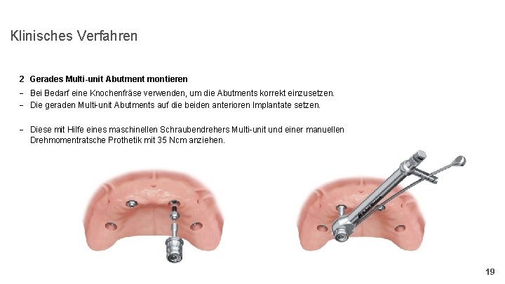 Klinisches Verfahren 2 Gerades Multi-unit Abutment montieren - Bei Bedarf eine Knochenfräse verwenden, um