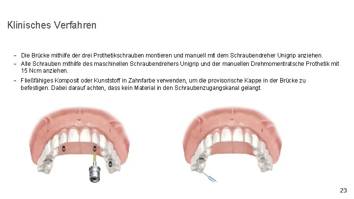 Klinisches Verfahren - Die Brücke mithilfe der drei Prothetikschrauben montieren und manuell mit dem