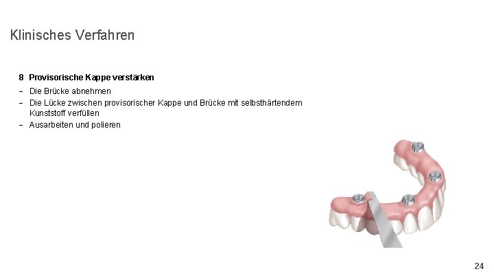 Klinisches Verfahren 8 Provisorische Kappe verstärken - Die Brücke abnehmen - Die Lücke zwischen