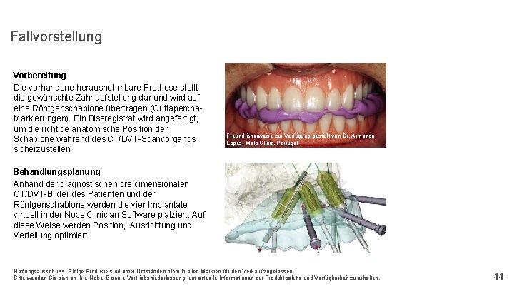 Fallvorstellung Vorbereitung Die vorhandene herausnehmbare Prothese stellt die gewünschte Zahnaufstellung dar und wird auf