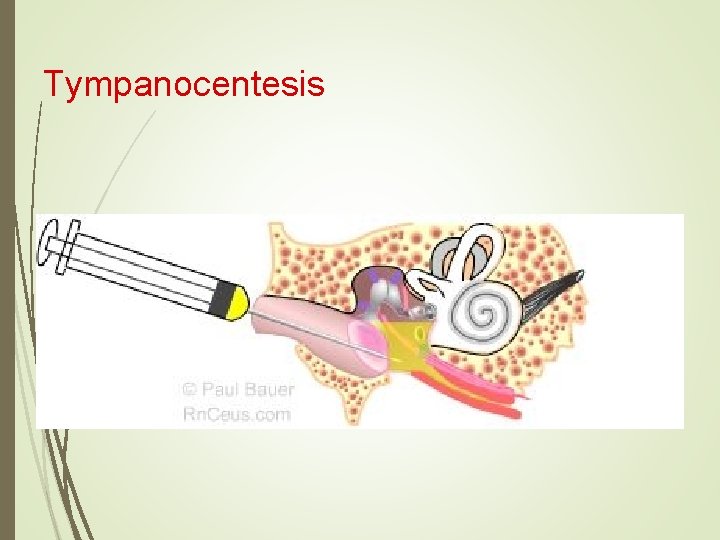 Tympanocentesis 