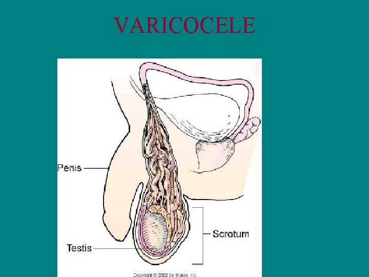 VARICOCELE 