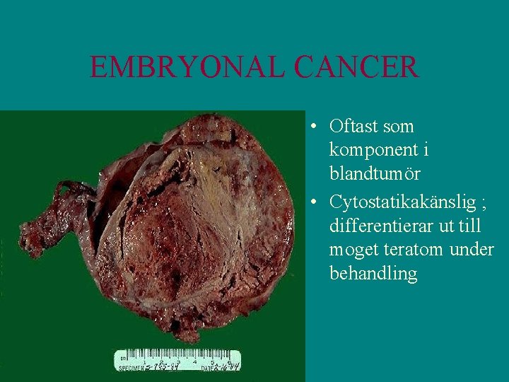 EMBRYONAL CANCER • Oftast som komponent i blandtumör • Cytostatikakänslig ; differentierar ut till