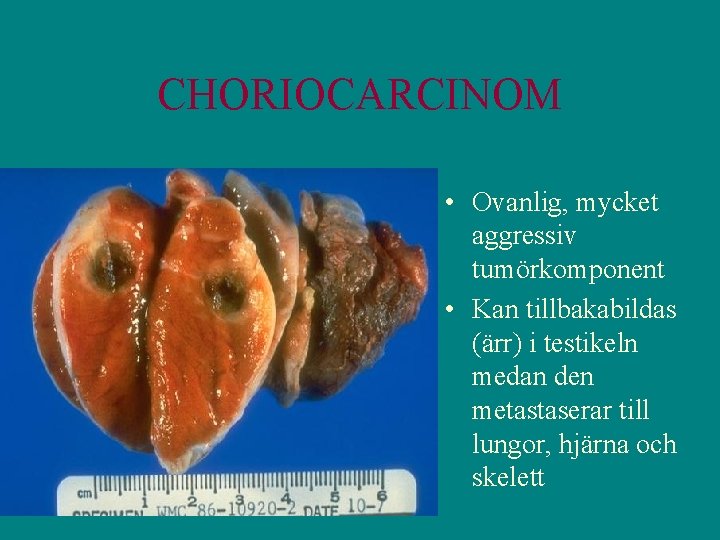 CHORIOCARCINOM • Ovanlig, mycket aggressiv tumörkomponent • Kan tillbakabildas (ärr) i testikeln medan den