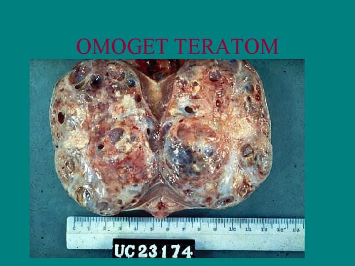 OMOGET TERATOM 