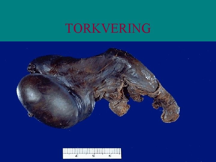 TORKVERING 