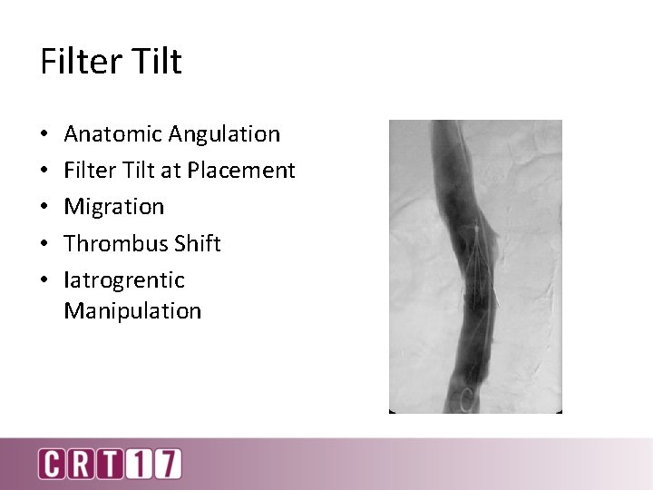 Filter Tilt • • • Anatomic Angulation Filter Tilt at Placement Migration Thrombus Shift