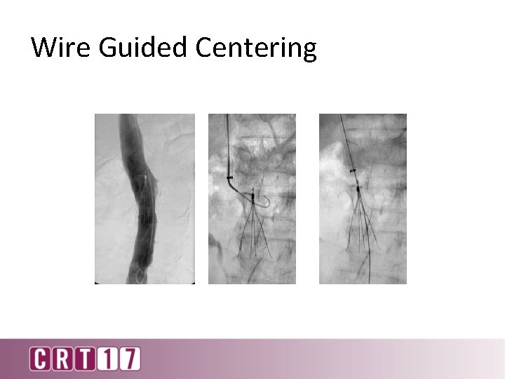 Wire Guided Centering Use wire to keep sheath& filter aligned 