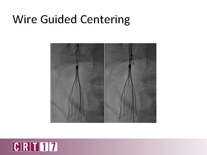 Wire Guided Centering 