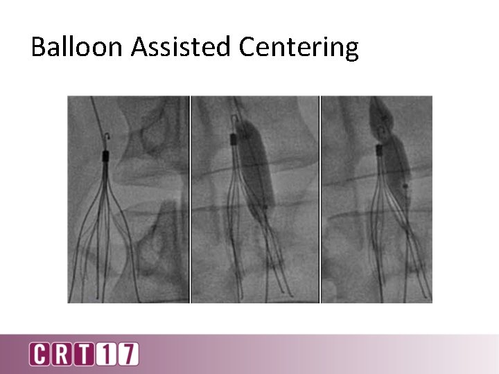 Balloon Assisted Centering 