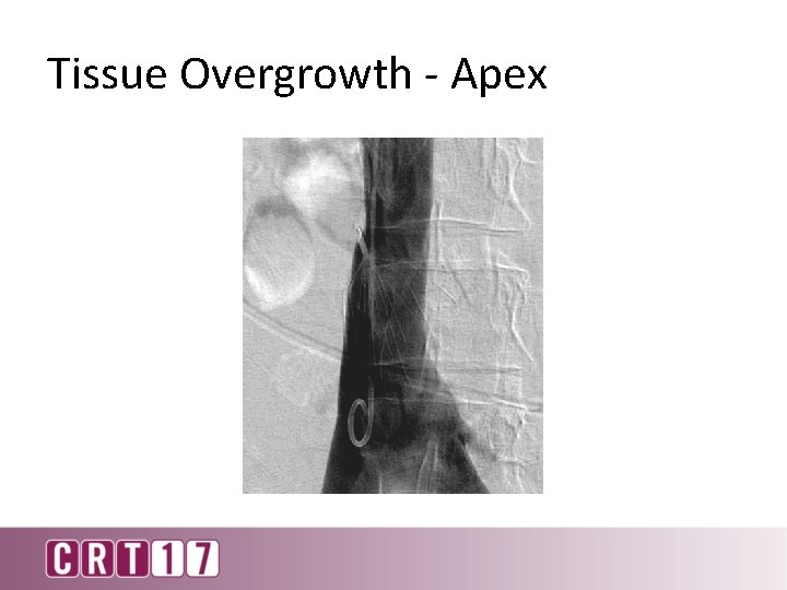 Tissue Overgrowth - Apex 