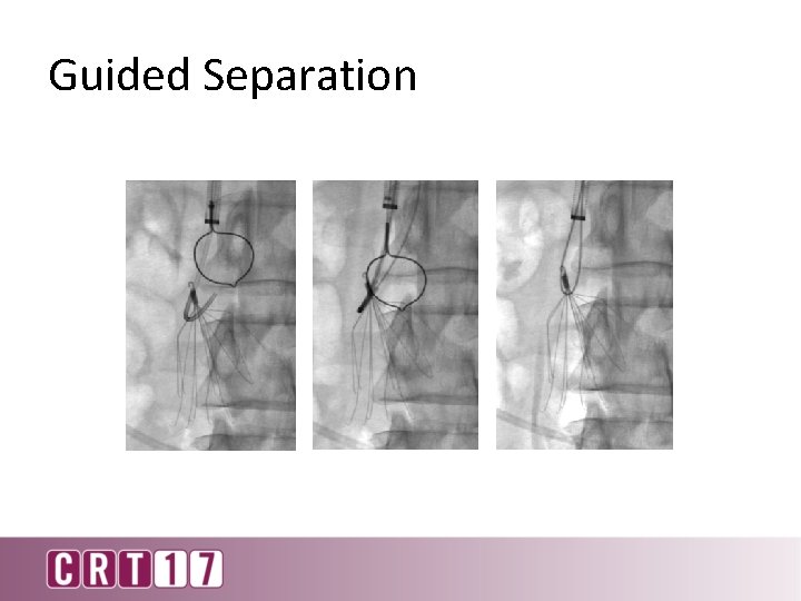 Guided Separation “Hangman” technique 