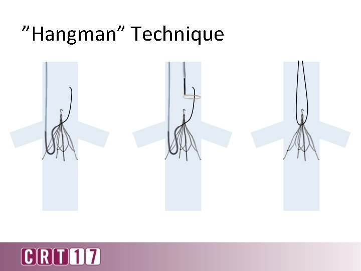 ”Hangman” Technique 