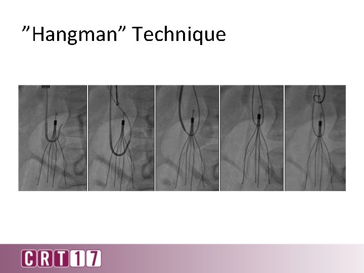”Hangman” Technique 