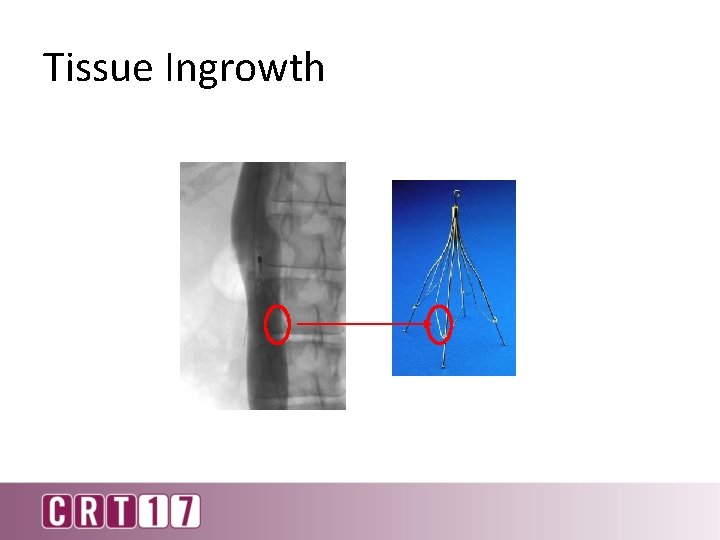 Tissue Ingrowth 