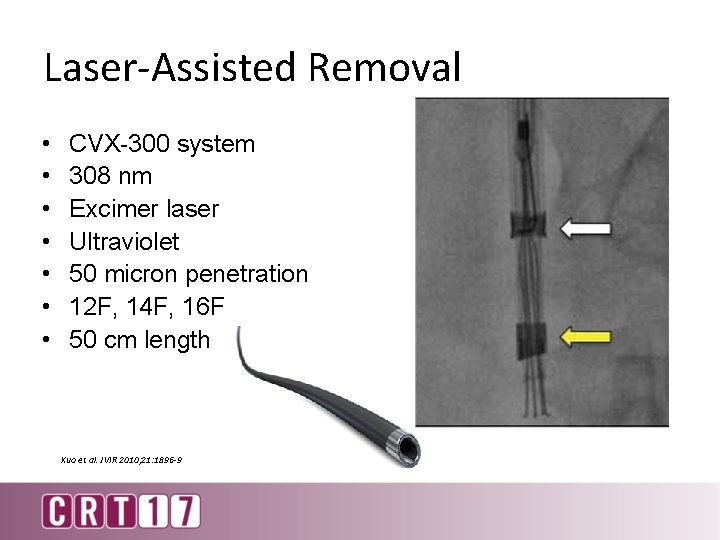 Laser-Assisted Removal • • CVX-300 system 308 nm Excimer laser Ultraviolet 50 micron penetration