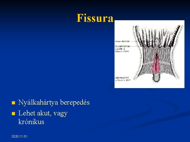 Fissura n n Nyálkahártya berepedés Lehet akut, vagy krónikus 2020. 11. 01. Fissura n n Nyálkahártya berepedés Lehet akut, vagy krónikus 2020. 11. 01.
