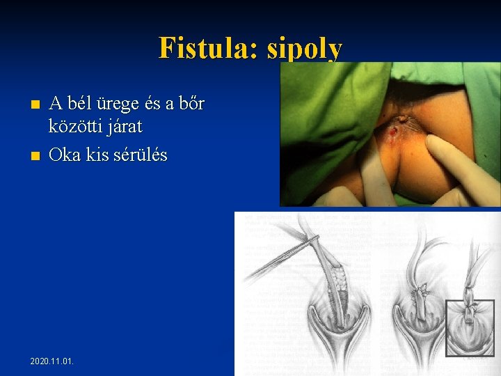 Fistula: sipoly n n A bél ürege és a bőr közötti járat Oka kis Fistula: sipoly n n A bél ürege és a bőr közötti járat Oka kis