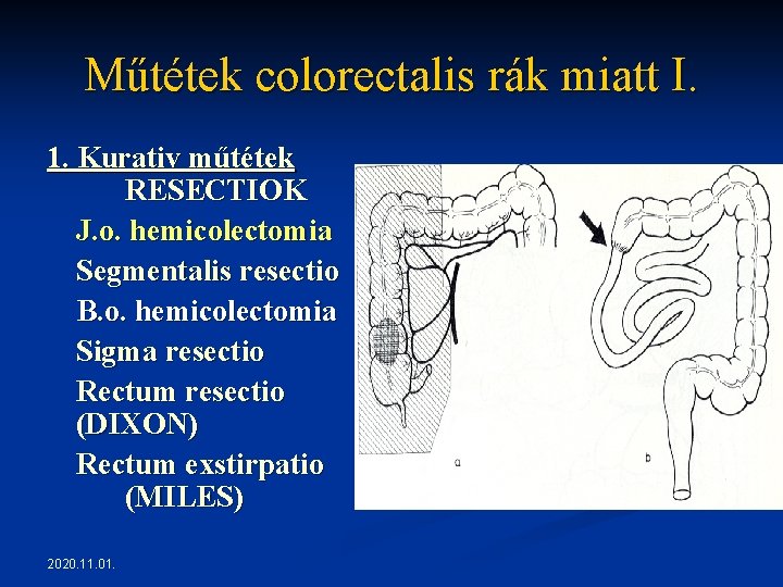 Műtétek colorectalis rák miatt I. 1. Kurativ műtétek RESECTIOK J. o. hemicolectomia Segmentalis resectio Műtétek colorectalis rák miatt I. 1. Kurativ műtétek RESECTIOK J. o. hemicolectomia Segmentalis resectio