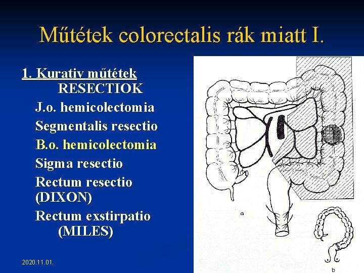 Műtétek colorectalis rák miatt I. 1. Kurativ műtétek RESECTIOK J. o. hemicolectomia Segmentalis resectio Műtétek colorectalis rák miatt I. 1. Kurativ műtétek RESECTIOK J. o. hemicolectomia Segmentalis resectio