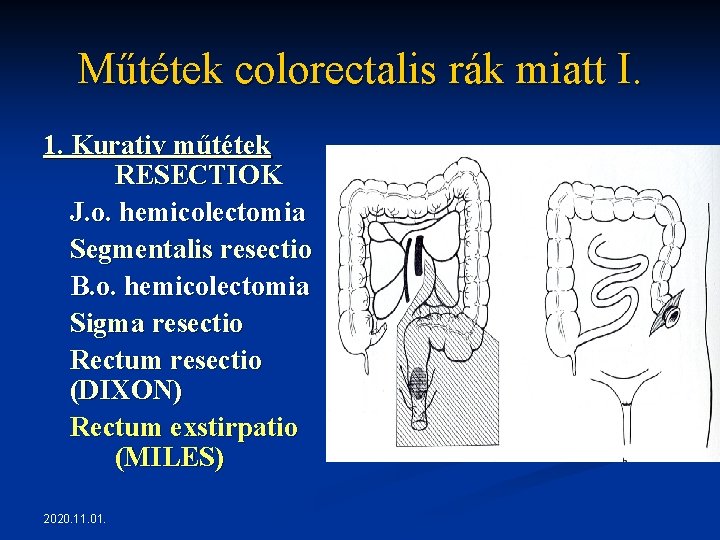 Műtétek colorectalis rák miatt I. 1. Kurativ műtétek RESECTIOK J. o. hemicolectomia Segmentalis resectio Műtétek colorectalis rák miatt I. 1. Kurativ műtétek RESECTIOK J. o. hemicolectomia Segmentalis resectio