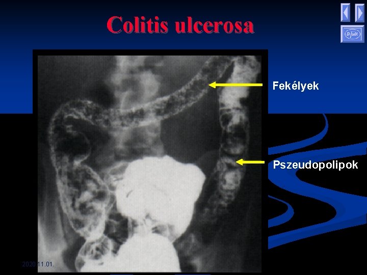 Colitis ulcerosa Fekélyek Pszeudopolipok 2020. 11. 01. Colitis ulcerosa Fekélyek Pszeudopolipok 2020. 11. 01.