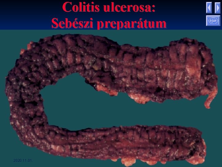 Colitis ulcerosa: Sebészi preparátum 2020. 11. 01. Colitis ulcerosa: Sebészi preparátum 2020. 11. 01.