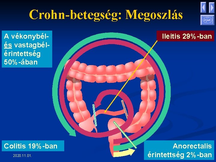 Crohn-betegség: Megoszlás A vékonybélés vastagbélérintettség 50%-ában Colitis 19%-ban 2020. 11. 01. Ileitis 29%-ban Anorectalis Crohn-betegség: Megoszlás A vékonybélés vastagbélérintettség 50%-ában Colitis 19%-ban 2020. 11. 01. Ileitis 29%-ban Anorectalis