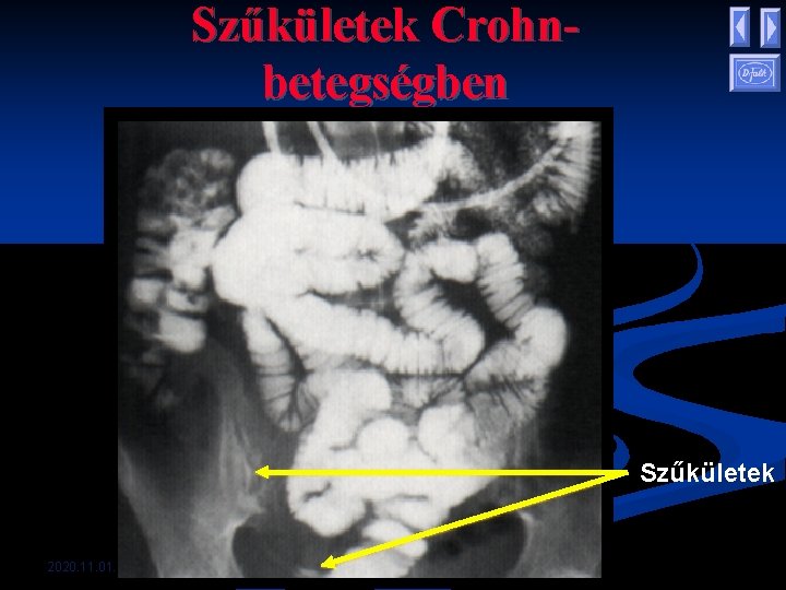 Szűkületek Crohnbetegségben Szűkületek 2020. 11. 01. Szűkületek Crohnbetegségben Szűkületek 2020. 11. 01.
