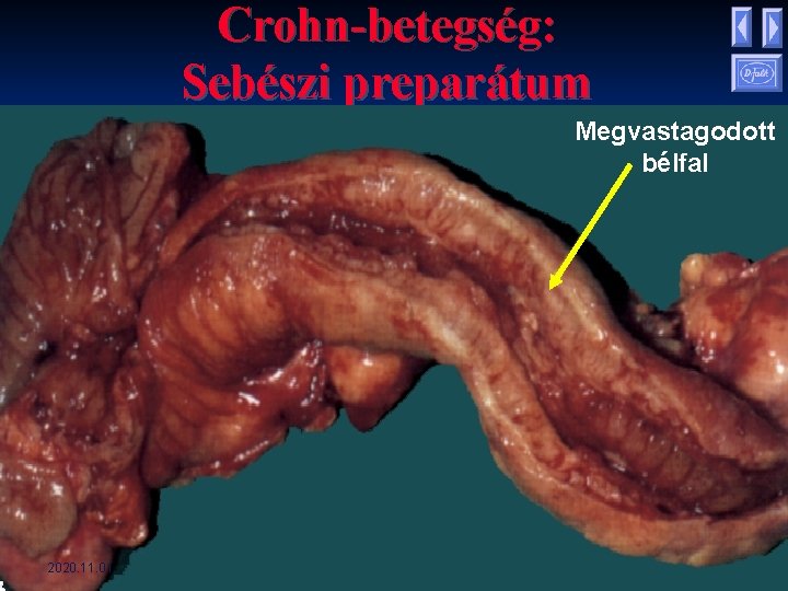 Crohn-betegség: Sebészi preparátum Megvastagodott bélfal 2020. 11. 01. Crohn-betegség: Sebészi preparátum Megvastagodott bélfal 2020. 11. 01.