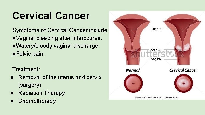 Cervical Cancer Symptoms of Cervical Cancer include: ●Vaginal bleeding after intercourse. ●Watery/bloody vaginal discharge.