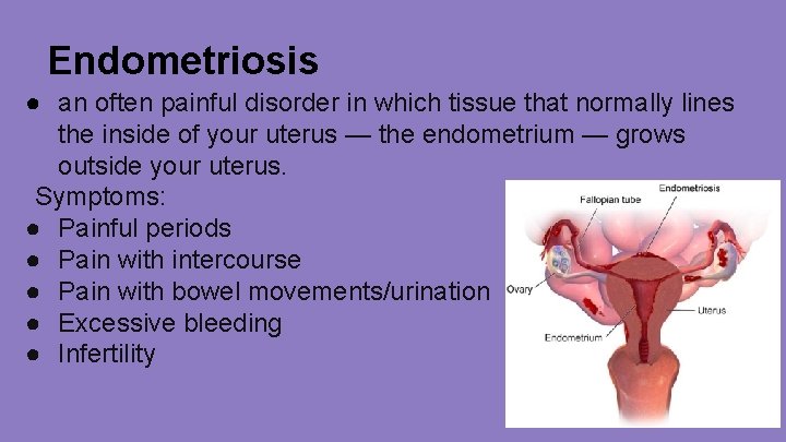 Endometriosis ● an often painful disorder in which tissue that normally lines the inside