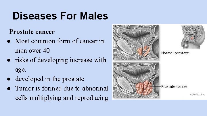 Diseases For Males Prostate cancer ● Most common form of cancer in men over