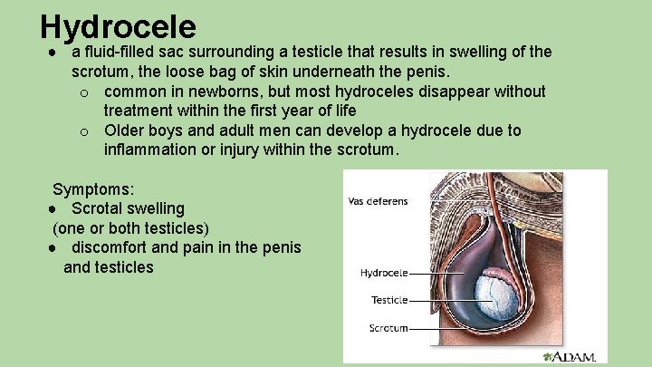 Hydrocele ● a fluid-filled sac surrounding a testicle that results in swelling of the