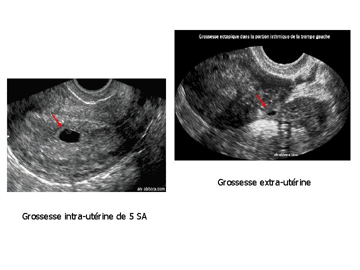 Grossesse extra-utérine Grossesse intra-utérine de 5 SA 