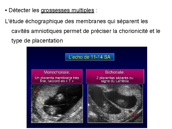  • Détecter les grossesses multiples : L'étude échographique des membranes qui séparent les