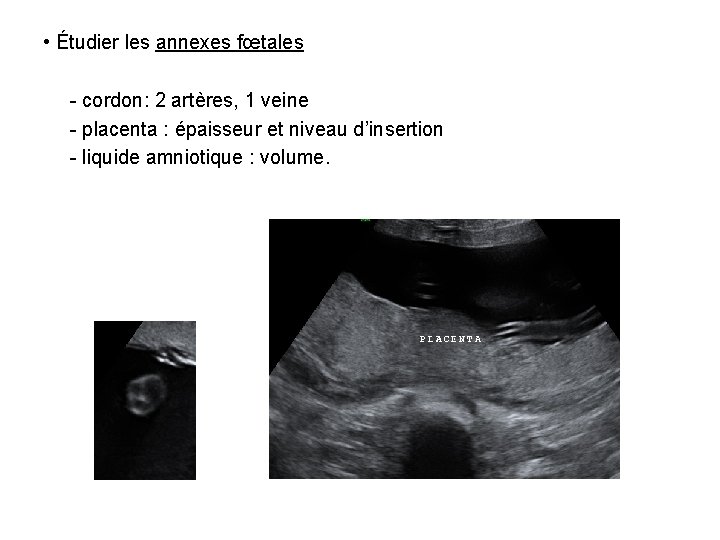  • Étudier les annexes fœtales - cordon: 2 artères, 1 veine - placenta