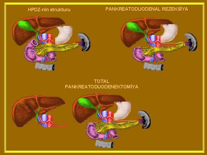 HPDZ-nin strukturu PANKREATODUODENAL REZEKSİYA TOTAL PANKREATODUODENEKTOMİYA 