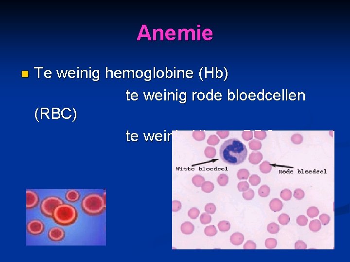 Anemie n Te weinig hemoglobine (Hb) te weinig rode bloedcellen (RBC) te weinig Hb