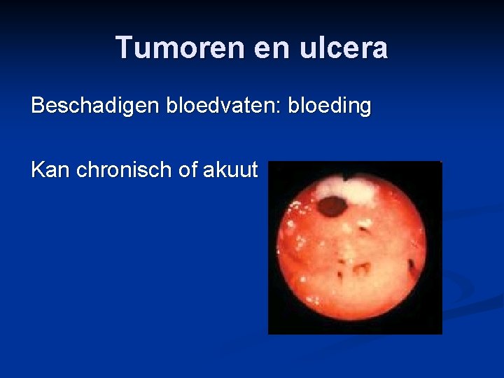 Tumoren en ulcera Beschadigen bloedvaten: bloeding Kan chronisch of akuut 