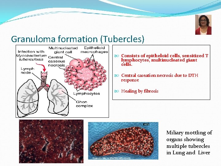 Granuloma formation (Tubercles) Consists of epitheloid cells, sensitized T lymphocytes, multinucleated giant cells. Central