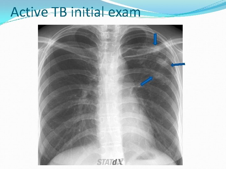 Active TB initial exam 