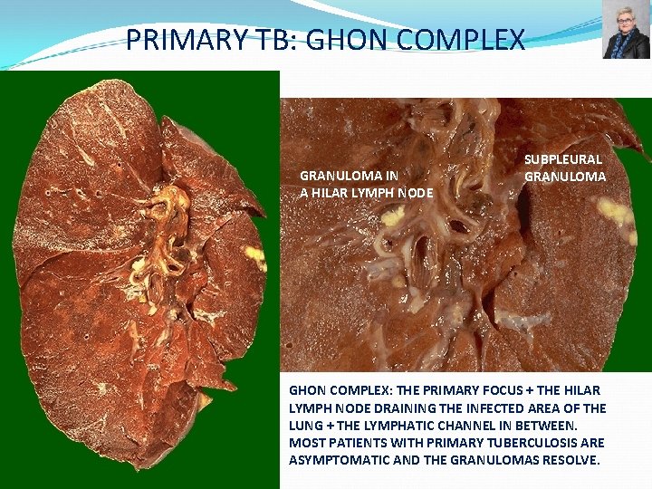 PRIMARY TB: GHON COMPLEX GRANULOMA IN A HILAR LYMPH NODE SUBPLEURAL GRANULOMA GHON COMPLEX: