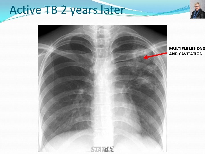 Active TB 2 years later MULTIPLE LESIONS AND CAVITATION 