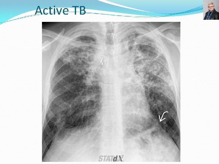 Active TB 